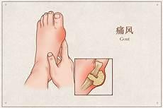 左腿浮肿什么原因